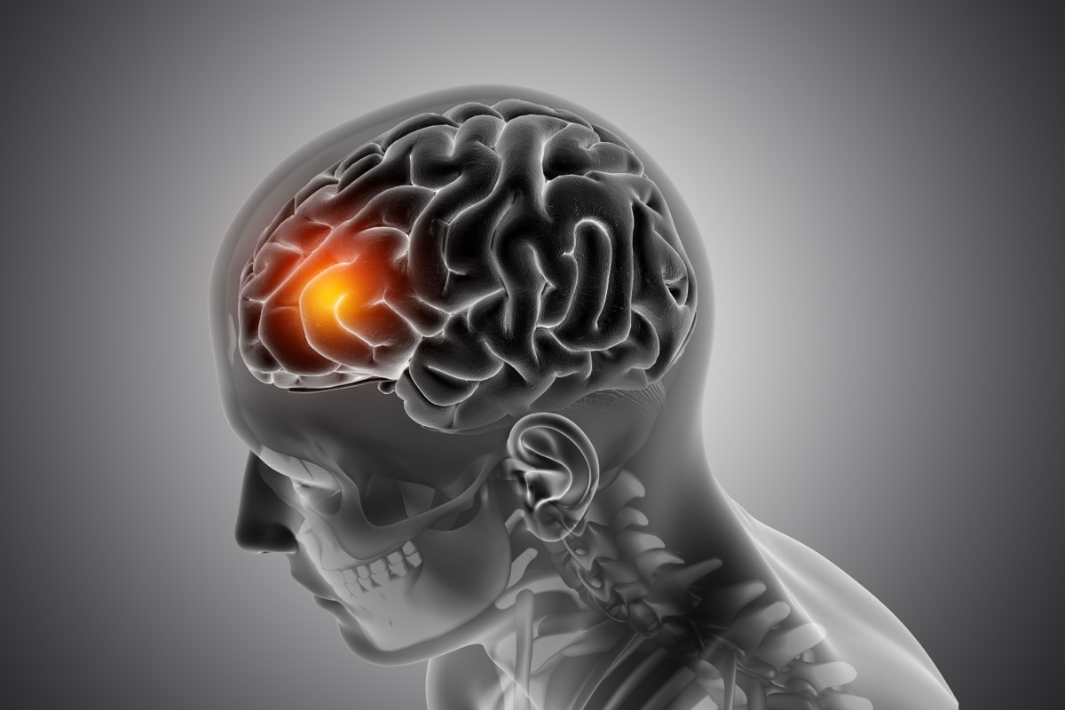 Brain Aneurysm Treatment