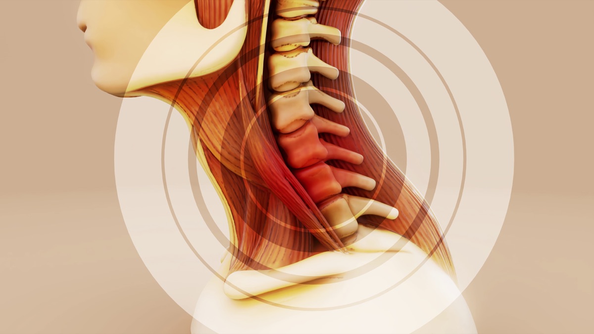 Carotid & Vertebral Artery Stenting